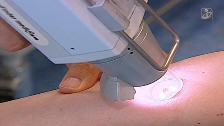 276 melanomas não foram diagnosticados em Portugal em 2020