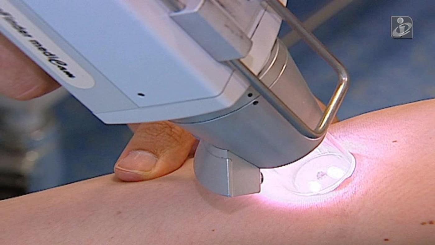 276 melanomas não foram diagnosticados em Portugal em 2020