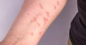 Mpox: Suécia anuncia deteção do primeiro caso do vírus fora de África&nbsp;